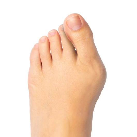 Bunions on Feet